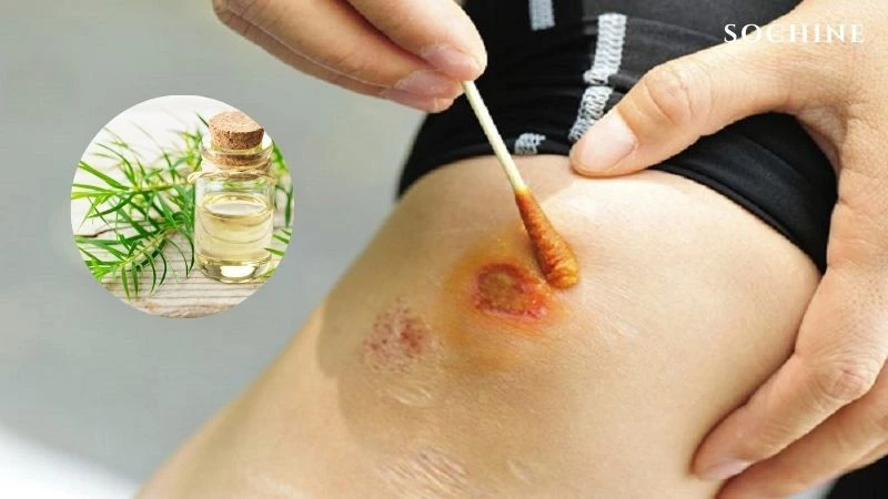 Tea tree là gì? Tác dụng và cách phân biệt với tràm gió 4 Tinh dầu tea tree hỗ trợ làm lành vết thương
